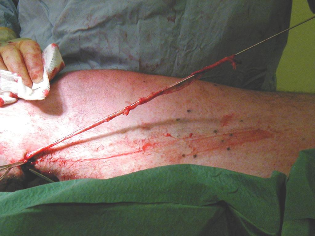 Surgical Vein Stripping - Blind procedure -