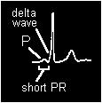 Wolf-Parkinson-White syndrome 1930 - WPW syndrome was defined as a combination of: delta wave, short PR, Tachycardia.