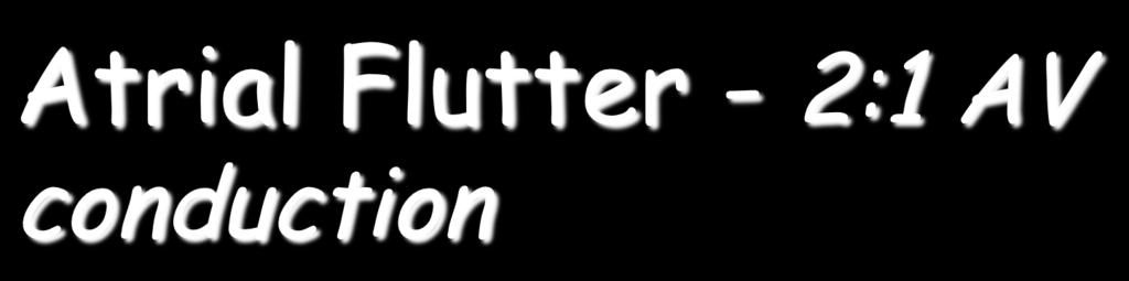 Atrial Flutter - 2:1 AV conduction The sawtooth