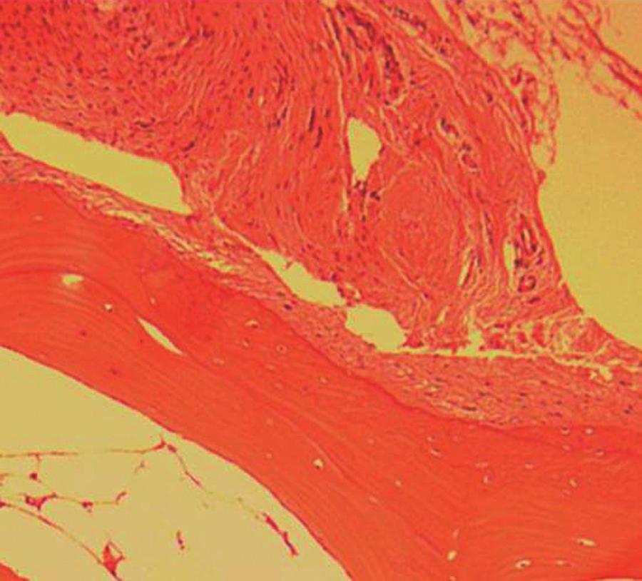 The deep of a trianglar fibrous cartilage attached to the fovea of the ulna. The histopathologic report of the loose bodies and resected synovium revealed primary synovial chondromatosis (Fig. 3).