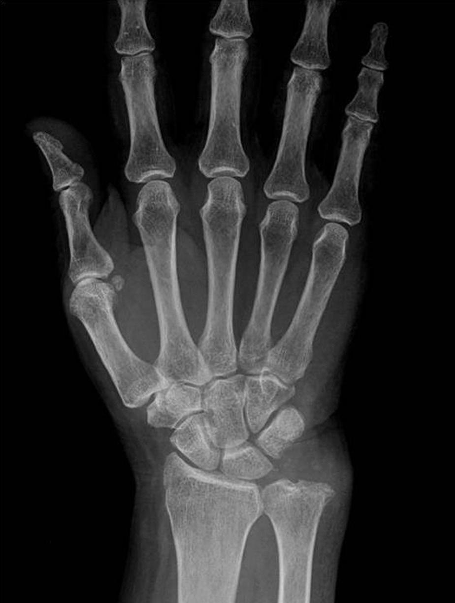 Sung-Guk Kim, et al. Synovial Chondromatosis of the Ulnocarpal Joint Fig. 4.