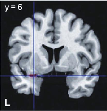 ADOUCEUR et al. FIGURE 3 (A) Neural connectivity between bilateral ventromedial prefrontal cortex (VMPFC) and right dorsolateral prefrontal cortex (DPFC) to happy faces.