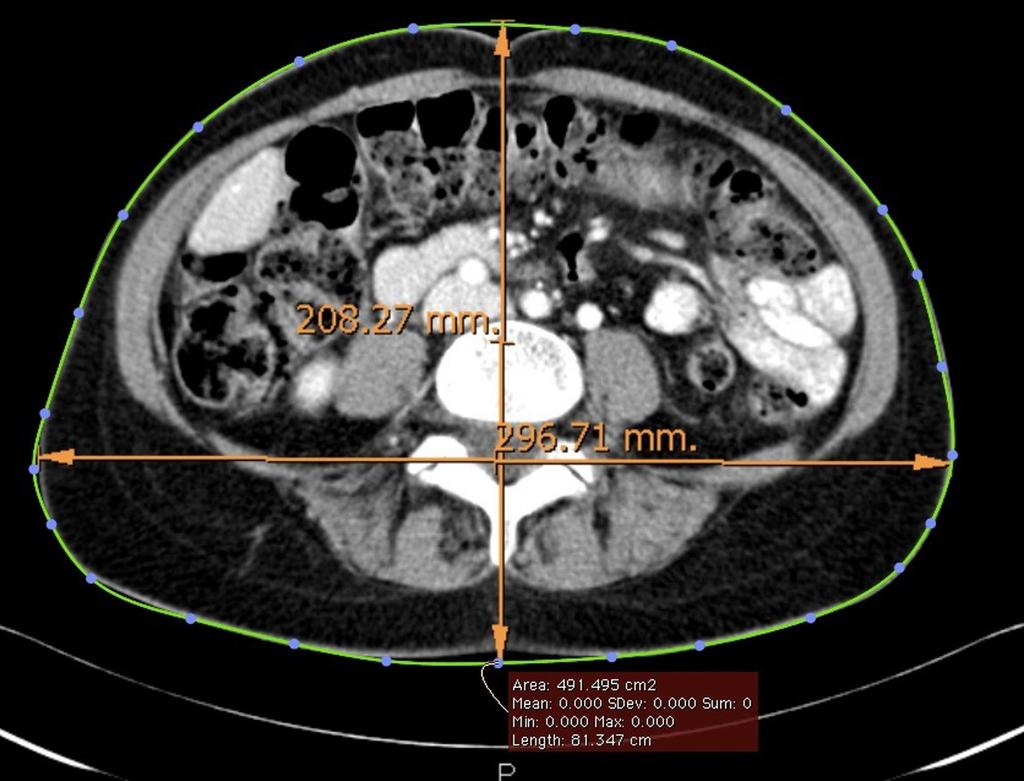 Fig. 1: Evaluation of the waist circumference on a CT image, using both a line to approximate the