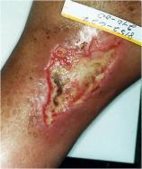 admissions for cellulitis Sen Chandan, Gordillo Gayle, Roy Sashwat, Kirsner R, et al; Human skin wounds: A major and
