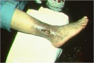 LEVD Edema Wound drainage Pain Periwound margins Skin changes Maceration Common characteristics of the venous ulcer