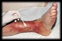 All Rights Reserved 42 Effect of Chronic Edema in Lower