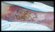 Inflammation of the epidermis and dermis Inside-out