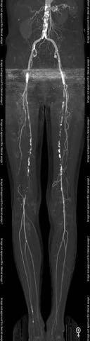 82 y.o. woman bilateral claudication re>lt Scanner: Scantime: 64 0.