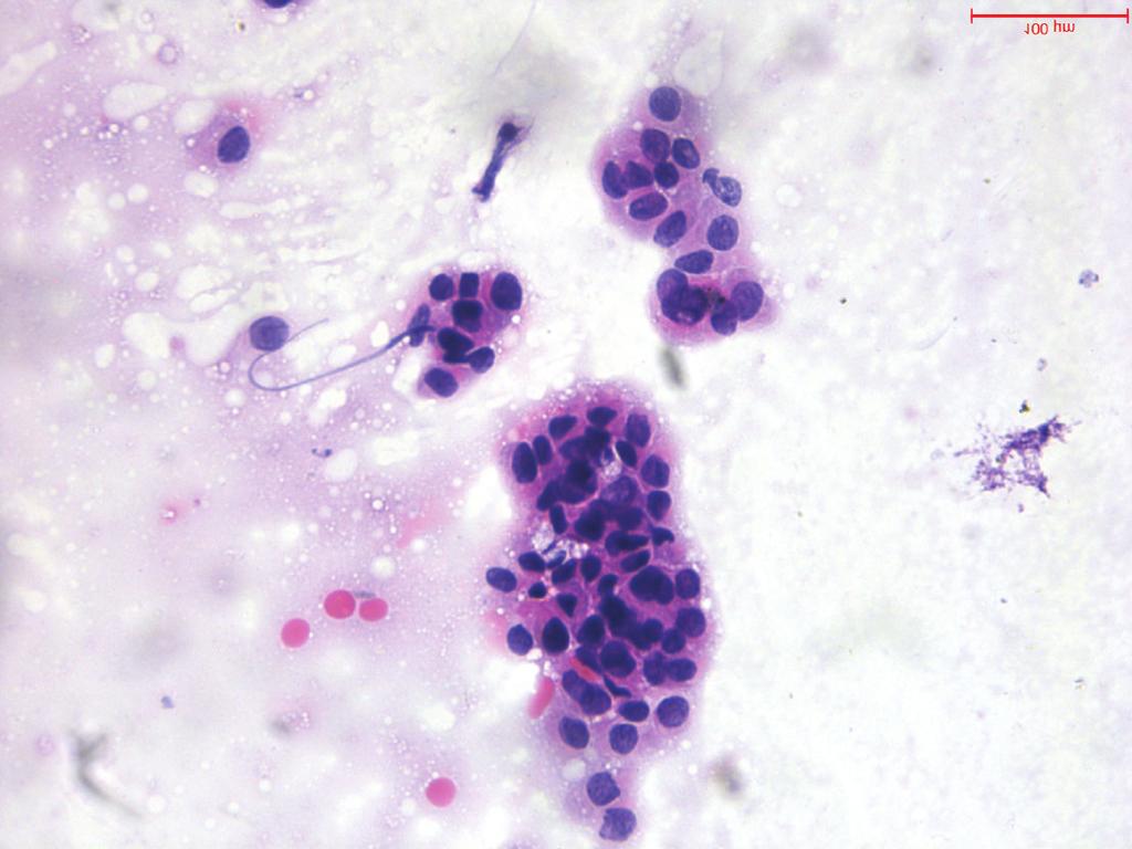 ) (c) and (d) show another papillary carcinoma case with AUS cytological diagnosis: (c), Hematoxylin-eosin; (d), RET/PTC1 rearrangement. (Original magnifications 200.