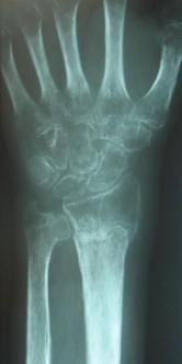 Slika 4. Mrljasta osteoporoza u CRPS (Izvor: www.