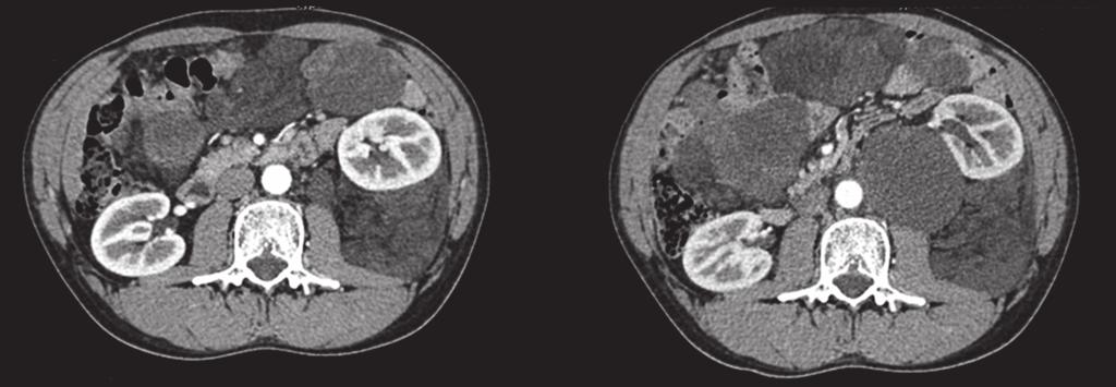 Sarcoma 3 Figure 1: Multidetector computed tomography (MDCT) scan after contrast medium (arterial phase).
