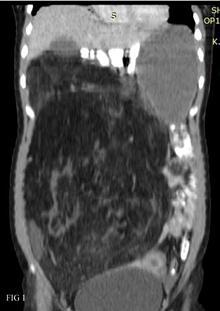 Figures 1 and 2: Coronal and axial contrast enhanced CT scans showing a large retroperitoneal fat-attenuation mass lesion