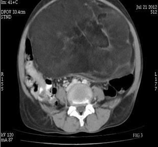 2 Figures 3 and 4: Axial contrast enhanced CT scans shows a large retroperitoneal fatattenuation mass lesion predominantly in