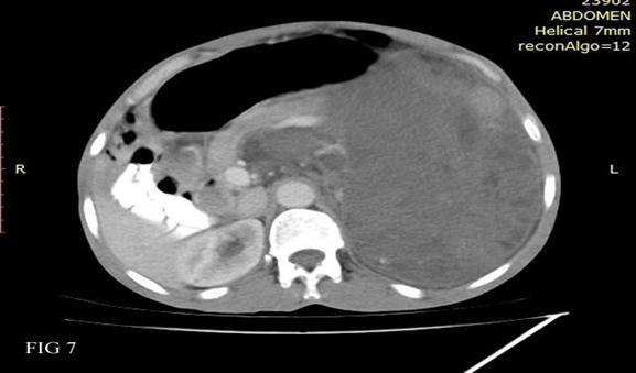 Figures 5, 6, 7: Axial contrast enhanced CT images showing a large left -sided retroperitoneal mass that is predominantly of soft-tissue attenuation with areas of fat attenuation at the periphery.