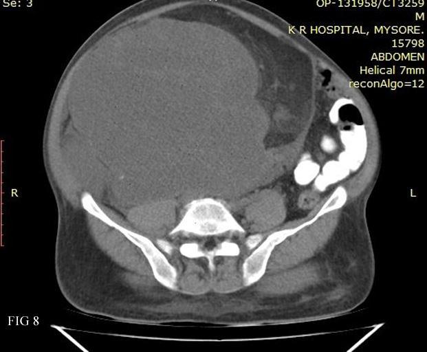 Figure 8: Axial CT image showing a soft-tissue mass within the region of residual well differentiated liposarcoma suggestive of myxoid deposits. Fig. 8 AUTHORS: 1. Shashikumar M. R. 2.