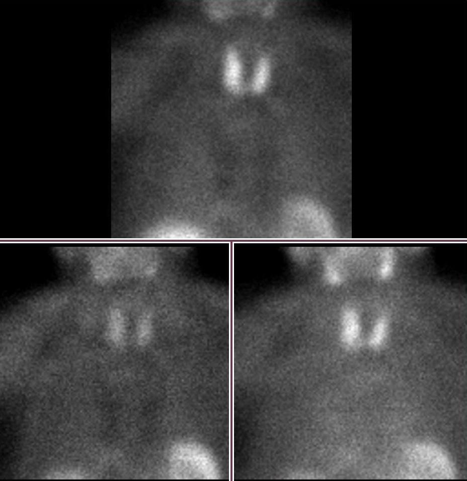 Planar images: no abnormal tracer uptake indicative of parathyroid