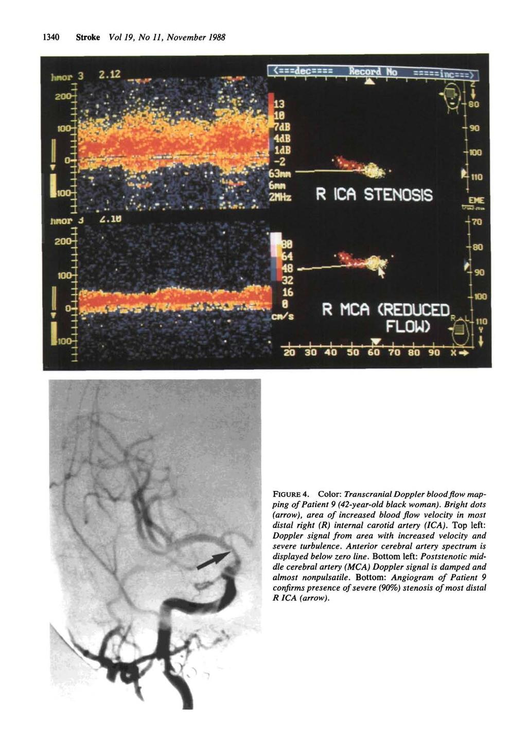 340 Stroke Vol 9, No, November 988 Downloaded from http://ahajournals.org by on October 8, 208 FIGURE 4. Color: Transcranial Doppler bloodflowmapping of Patient 9 (42-year-old black woman).