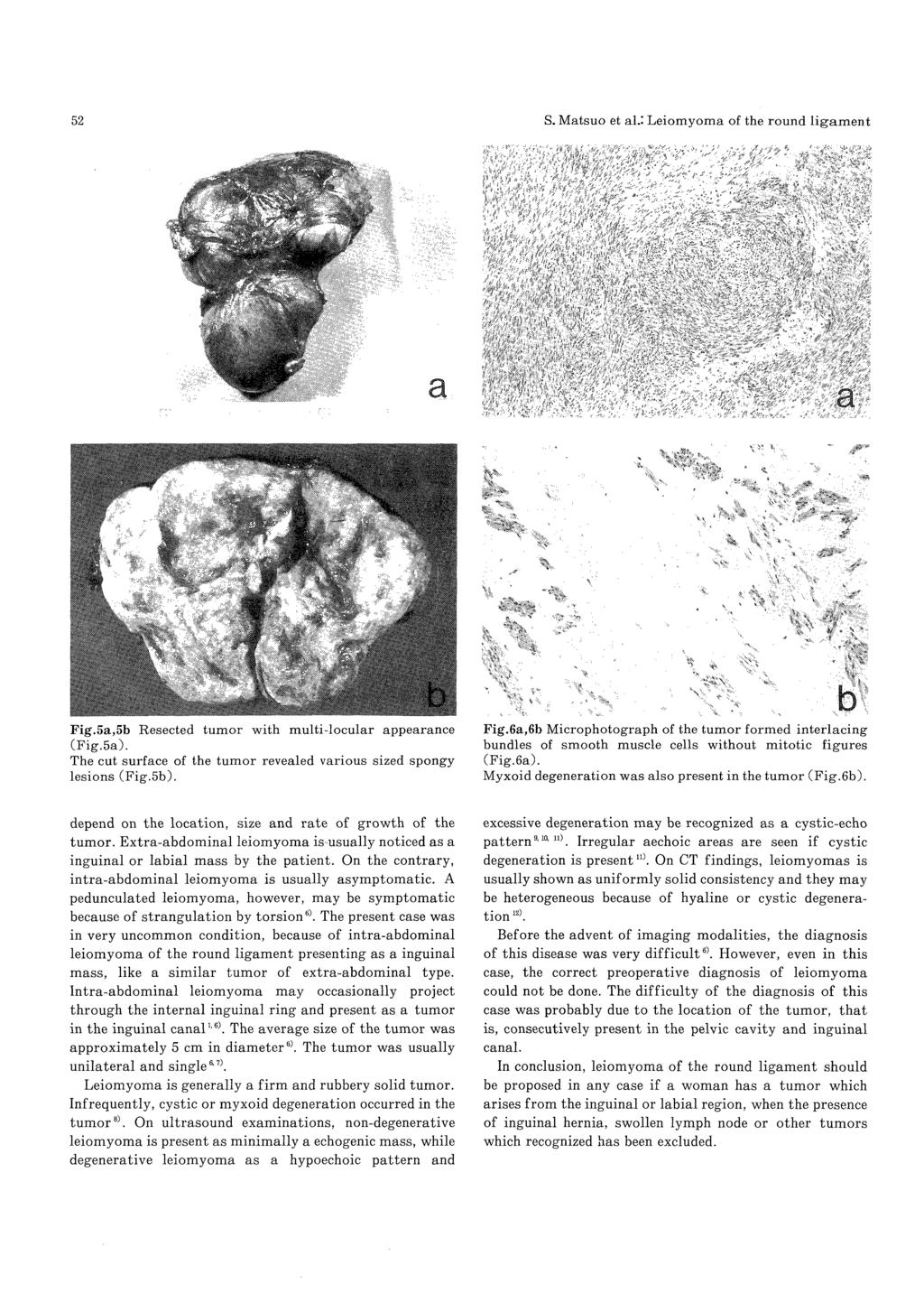 Fig.5a,5b Resected tumor with multi-locular appearance (Fig.5a). The cut surface of the tumor revealed various sized spongy lesions (Fig.5b). Fig.