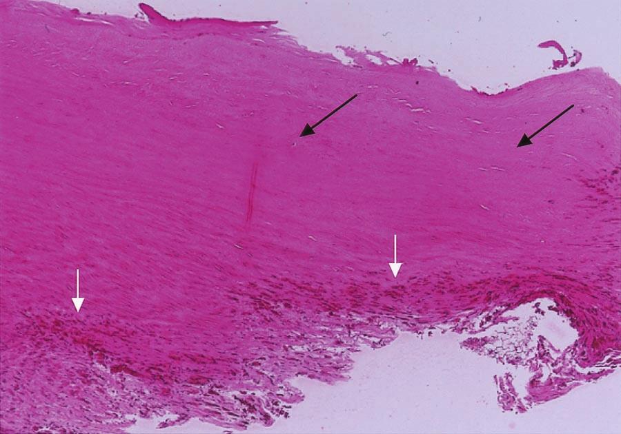 accidental injury to a branch of the previous arch graft that could not be repaired more conservatively. Figure 4 shows freedom from reoperation estimated by the Kaplan Meier method.