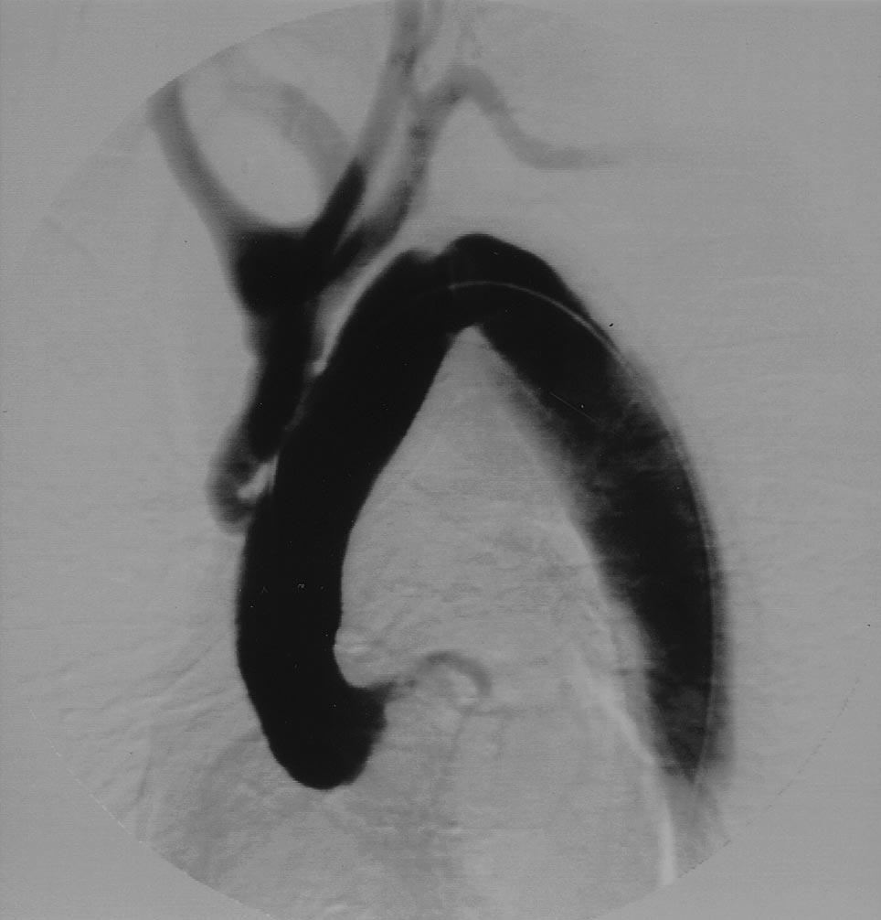 Two patients who required aortic root replacement for redissection underwent a third operation for aneurysmal dilation of the distal descending aorta: one had total thoracoabdominal aortic