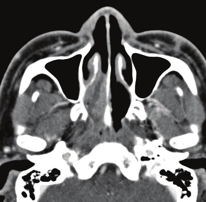 2 Case Reports in Otolaryngology (a) (b) (c) (d) Figure 1: Axial (a) and coronal (b) images of paranasal sinus computed tomography.