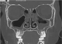 Chronic Rhinosinusitis: Diagnosis Chronic Rhinosinusitis (CRS) C P O D S Major Symptom Facial