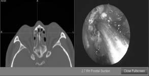 Endoscopy /- CT Scan Maximize Medical Therapy Consider Endoscopic Sinus Surgery?