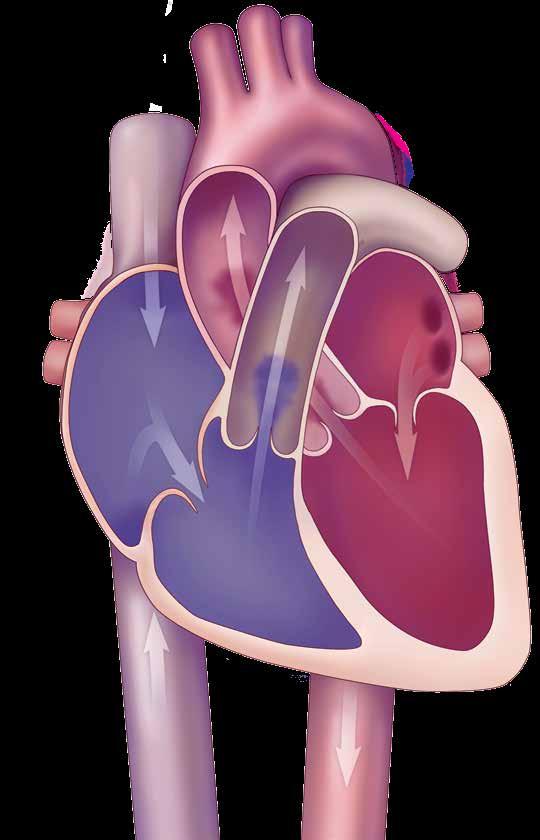 Right Ventricular Outflow Tract (RVOT) Right atrium The pulmonary valve has three leaflets.