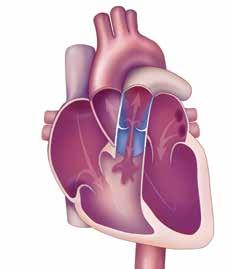 PULMONARY VALVE AND RVOT FAILURE As a result of a CHD, you may need multiple surgeries over the course of your life. Your valve or RVOT may narrow (stenosis) and/or leak (regurgitation).
