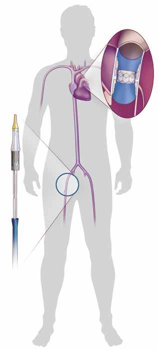 The SAPIEN XT TPV Therapy This information is meant to help you understand what may happen during TPV therapy. Each procedure is different.