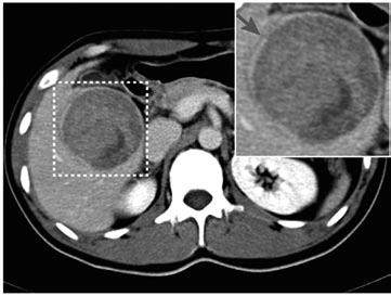 Zhang W et al. P reoperative prediction of HCC recurrence A B C Figure 2 Tumor capsules on the liver computed tomography map.