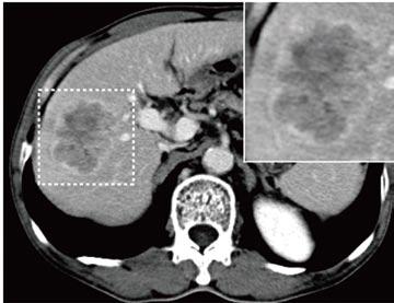 showing incomplete tumor capsule (red arrow) at liver segments V and VI in a 57-year-old female patient with postoperative recurrence (dashed box); C: Equilibrium phase CT showing missing tumor