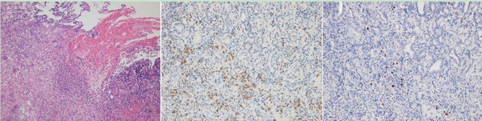 There was also extensive coagulative necrosis indicative of splenic infarction; B: Lymphoma cells were found in the stomach wall near the gastrosplenic fistula on hematoxylin-eosin stain (left), and