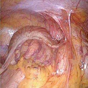 Dilatation of the terminal ileum is observed (black arrows). C: A colonoscopic view of the intussusception.