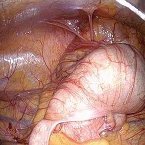 A B Appendix Cecum Ascending colon Cecum Ileum Appendix Figure 2 Laparoscopic view.