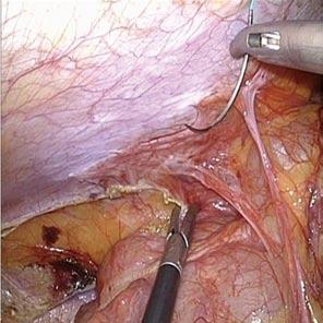 The cecum was not attached to the retroperitoneum (black arrows); B: The cecum was easily moved to the upper abdomen.
