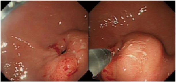 Wolpert LE et al. Endoscopic management of BBS A B C Figure 2 Endoscopic removal of a buried percutaneous endoscopic gastrostomy bumper using the HookKnife technique.