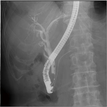 Yamamoto K et al. Biopsy forceps for diagnosing biliary strictures A B Figure 2 Fluoroscopic images during endoscopic retrograde cholangiopancreatography.