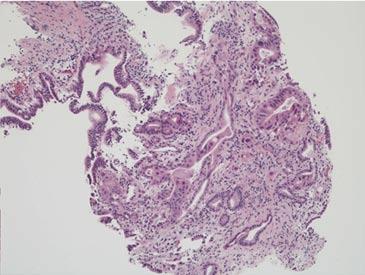 Yamamoto K et al. Biopsy forceps for diagnosing biliary strictures A B Figure 3 Biopsy specimens obtained using Radial Jaw 4P. The biopsy specimen obtained was sufficient and included adenocarcinoma.