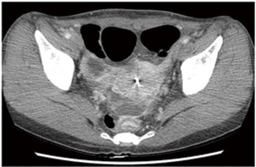 gastric cancer 17 mo prior. A: Contrast-enhanced abdominal computed tomography shows enhanced peritoneal thickening (arrow) with ascites.
