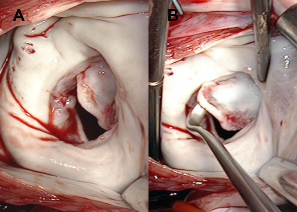 Intraoperative findings Both leaflets were prominently and excessively thickened at their free margins, with