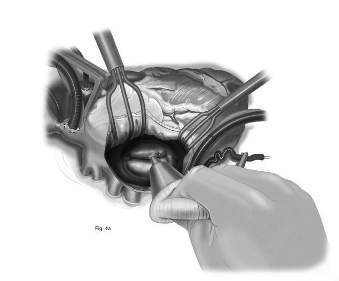 Assessment of mitral valve anatomy Particular attention should be given to the leaflet coaptation, the chordae