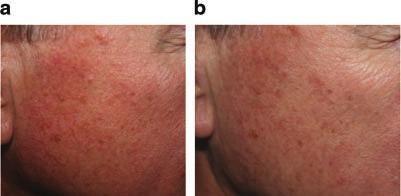 560 TIERNEY AND HANKE Fig. 3. a,b: Pre (left) and post (right) 65-year-old Caucasian male status post two treatments with diode laser (Varilite laser, Iridex Corp.) at 100 J/cm 2, 21 milliseconds.