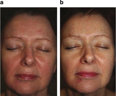 Two patients developed post-inflammatory hyperpigmentation which subsequently resolved.