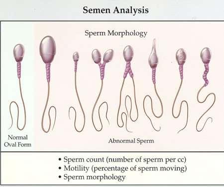2- Follicle stimulating hormone (FSH): It binds to Sertoli cells stimulating testicular fluid production. Abnormal sperm: They are frequent.