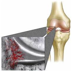 MENISCAL TEAR WHAT TO DO?