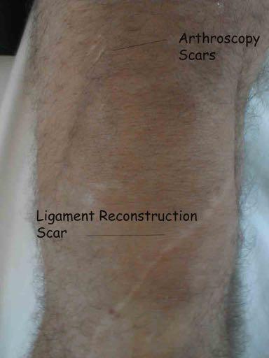 LOOK Bruising Knee Effusion Scars Knee