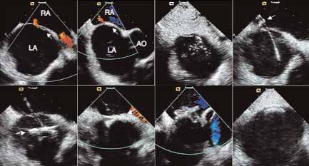 A B C D E F G H Figure 7. Evaluation of a PFO communication and the steps involved in deployment of the Helex septal occluder (W. L. Gore & Associates, Flagstaff, AZ).