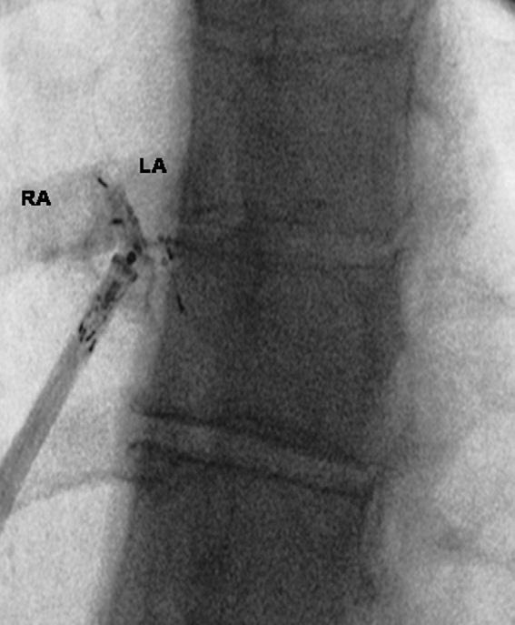 JACC: CARDIOVASCULAR INTERVENTIONS, VOL. 1, NO. 4, 2008 389 Figure 1. Contrast Assessment of the Positioning of the Device After Deployment of the LA Disc LA left atrium/atrial; RA right atrium.