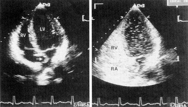 FIGURE 7 83. Apical four-chamber view recorded in a patient with an atrial septal aneurysm. Note the marked bulging of the atrial septum into the cavity of the left atrium (arrow).